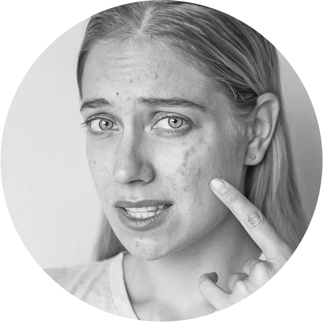 DermaRollers 4 Acne Scars 2