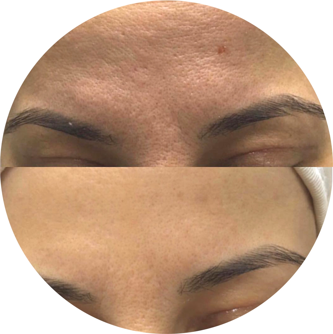 Before & After 2 derma roller before after 2