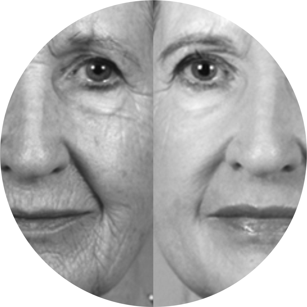 Before & After 1 derma roller before after 3