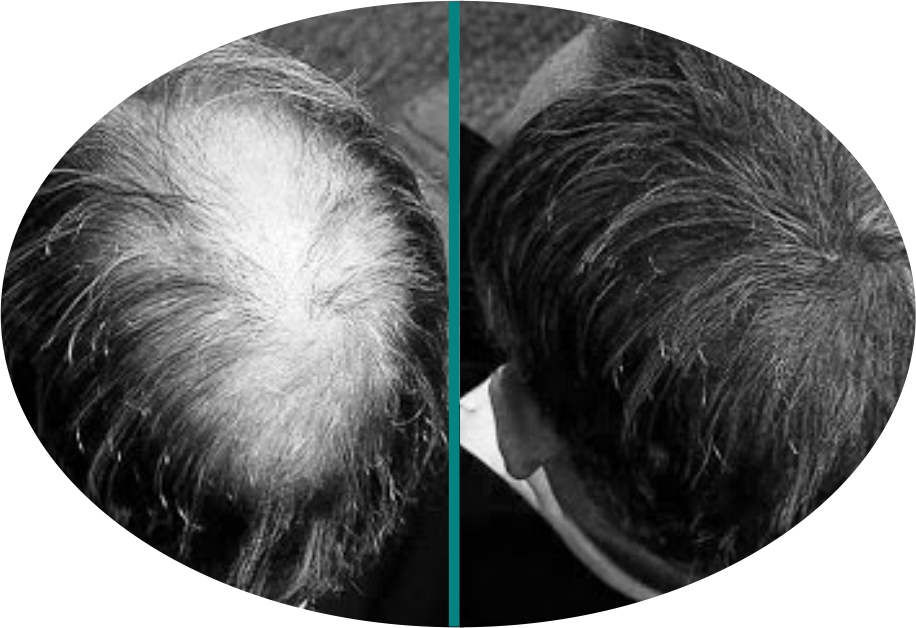 Before & After 8 derma roller before after 4