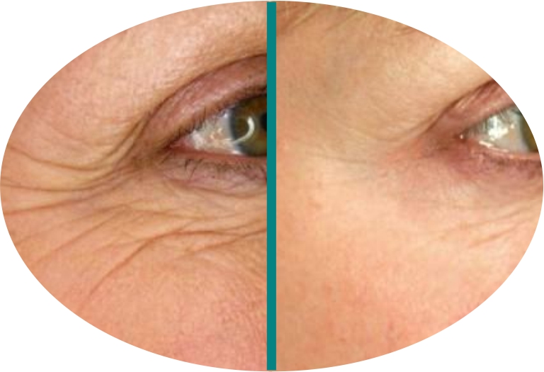 Before & After 7 derma roller before after 5