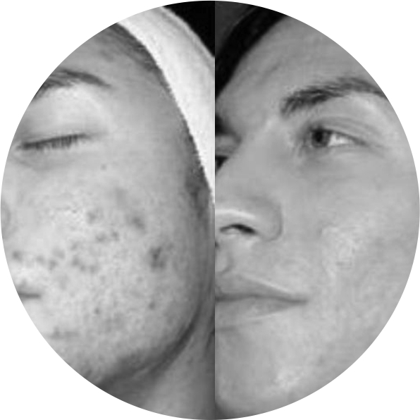 Before & After 3 derma roller before after 6