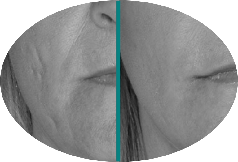 Before & After 6 derma roller before after 7