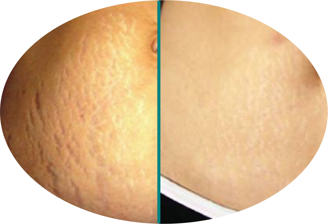 Before & After 5 derma roller before after 8