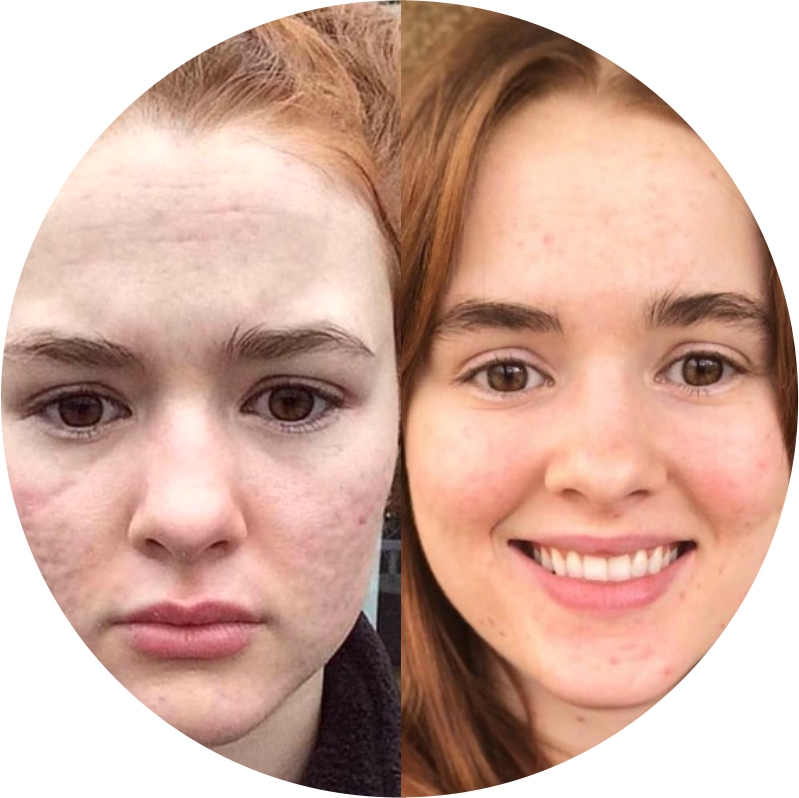 Before & After 4 derma roller before after 9