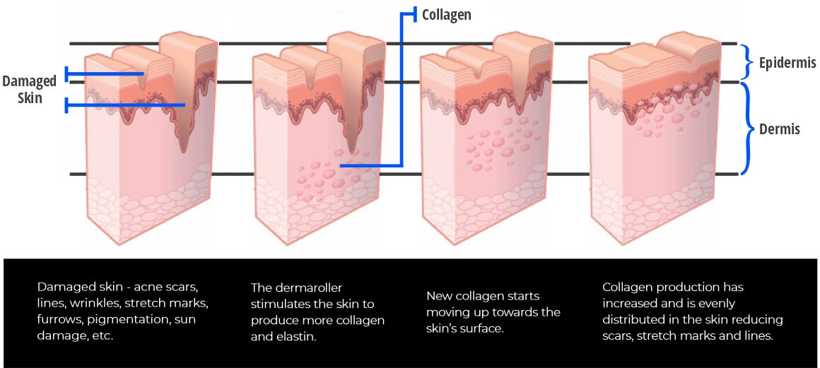 dermarollers for anti-ageing
