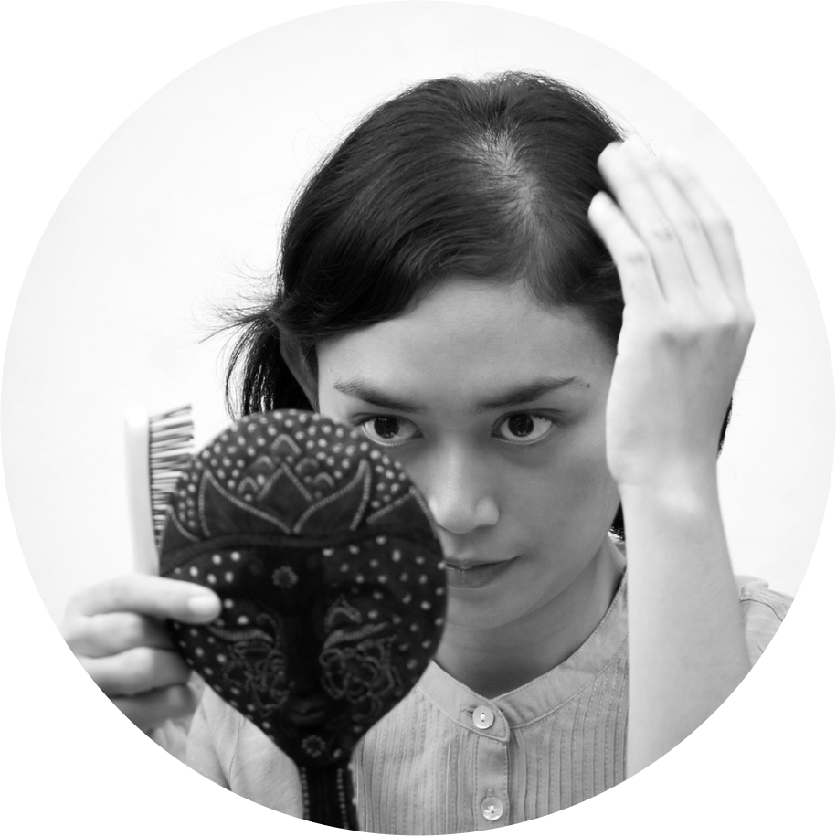 dermaroller hair loss 3