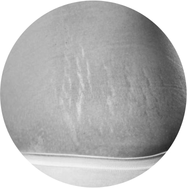 stretch marks